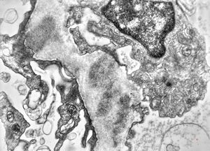 F,16y. | type III membranoproliferative glomerulonephritis F,16y. | type III membranoproliferative glomerulonephritis